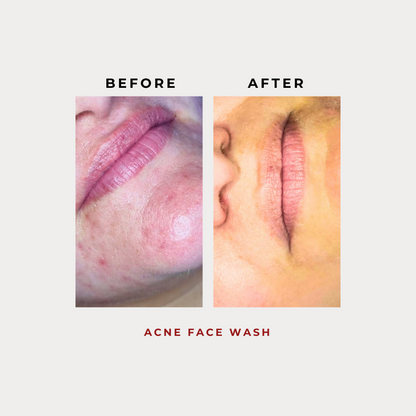 Acne Face Wash 100G