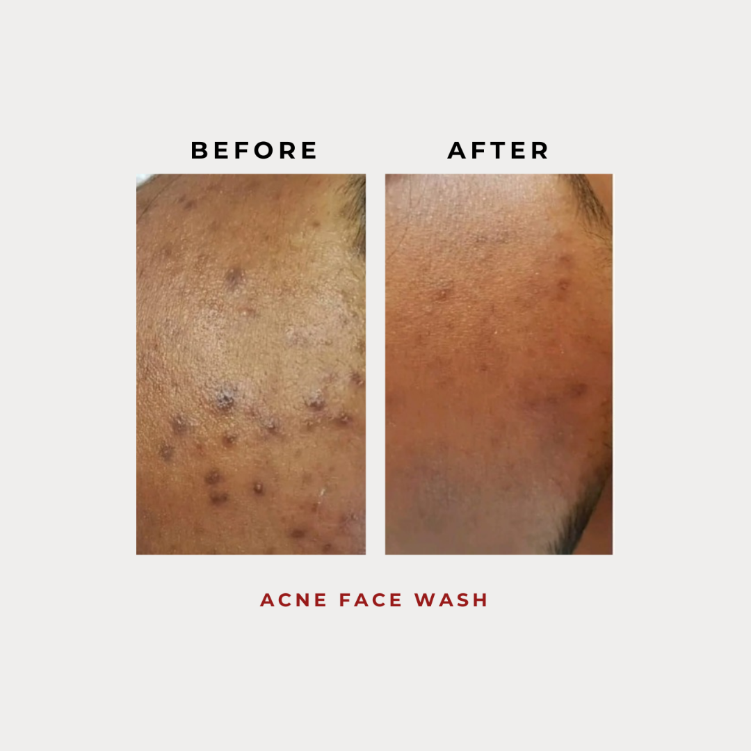 Acne Face Wash 100G