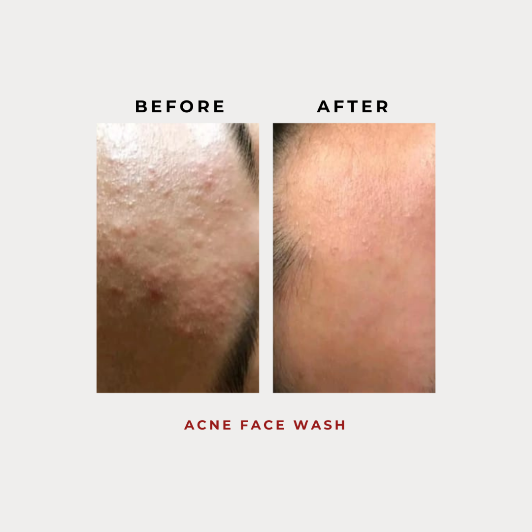 Acne Face Wash 100G